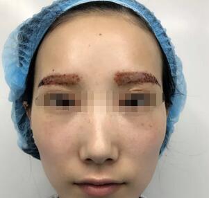 武汉美都整形医院张召医生做的假体丰太阳穴效果怎么样
