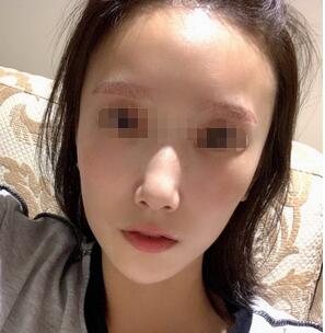 武汉美都整形医院张召医生做的假体丰太阳穴效果怎么样