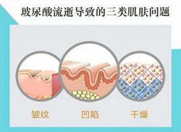 皮肤内的玻尿酸流失，皱纹？凹陷？没有玻尿酸，何来做女神？