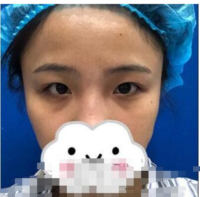 双眼皮案例 术后三个月素颜都可以美美哒出门了
