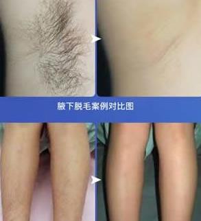 杭州维多利亚整形胡珊莺医生腋下脱毛效果如何?