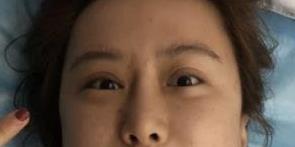 双眼皮案例 为你打造专属媚眼