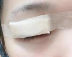 双眼皮修复案例 10年间技术进步很大了