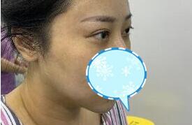 還有沒有得少？烏魯木齊面頰部填充價格