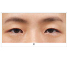 烏魯木齊上瞼松弛矯正手術的參考價格是多少：5000-10000元/例