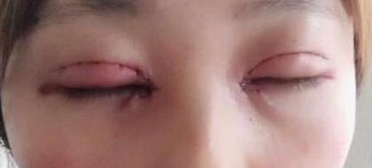 双眼皮案例 术后终于能驾驭现在的“口罩妆”美美哒