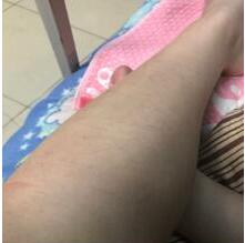 興安大小腿脫毛十月全新價格表 4000-6000元/療程 