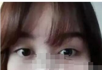 双眼皮案例 眼睛变得特别的好看