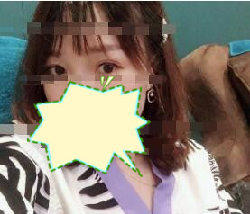 双眼皮案例 美丽大眼睛改变整个美丽形象