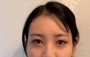 双眼皮案例 术后颜值飙升 回头看超高