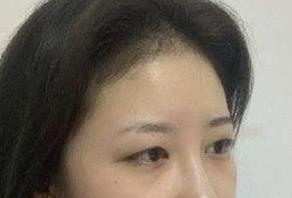 双眼皮案例 术后颜值飙升，男盆友说我变漂亮了