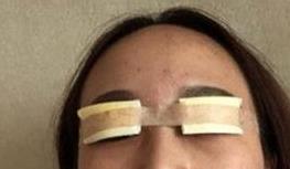 双眼皮案例 术后眼睛很美，爱了爱了