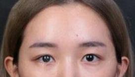 双眼皮案例 盆友们都夸我变优雅漂亮多了
