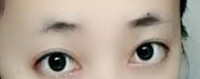 烏魯木齊的瞼眶溝填充可參考的價格為：5000-11000元/例
