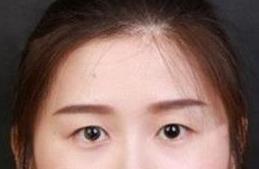双眼皮案例 术后颜值直飙升，气质都提升了