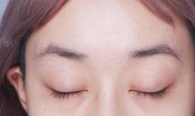 双眼皮案例 术后眼睛又亮又迷人 越来越有气质了