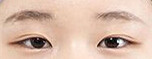 烏魯木齊三角眼矯正參考報價是多少：3000-7000元/例