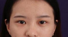 双眼皮案例 眼睛变得又大又圆 显得整个人很有气质