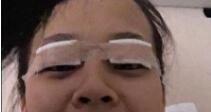 双眼皮案例 眼睛变美后心情也变得美美哒