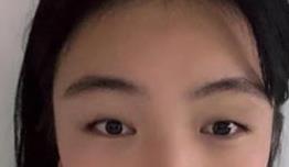 双眼皮案例 没想过我能这么漂亮！秒变小仙女一枚