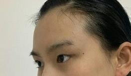 双眼皮案例 术后颜值飙升 就算是素颜也很美！