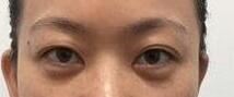 烏魯木齊的水泡眼矯正手術的參考價格是多少呢：2000-5000元/例