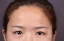 双眼皮案例 术后眼睛无需化妆都美美哒