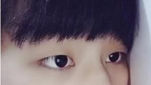 双眼皮案例 做了一个8毫米的双眼皮 眼睛更大更美了
