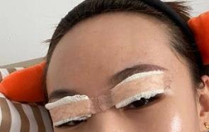 双眼皮案例 术后眼睛也很亮，给人一种通透的感觉