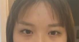 双眼皮案例 术后眼睛变得又大又亮 秒变小仙女