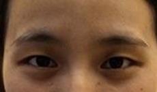 双眼皮案例 小姐姐一个月恢复的逼真又迷人