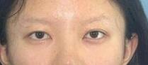 双眼皮案例 心情从烦躁到变得轻松，持续一个月时间