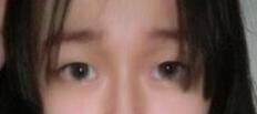 双眼皮案例 术后的眼皮弧度是一天比一天自然