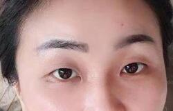 双眼皮案例 眼睛恢复好看后走到哪里都夸我长得好看