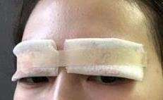 双眼皮案例 术后颜值自然而然也跟着提升了~