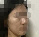 沈阳元辰杨晓月医生在微整形注射量的把控方面做得如何?