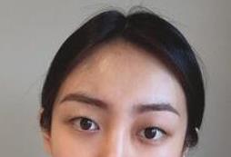 双眼皮案例 轻松甩掉“肿眼泡”眼睛发出迷人信号！