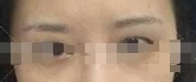 【单眼皮锐变双眼皮案例惊喜】 上海双眼皮手术真人案例效果分享