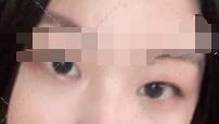 【谁说单眼皮不能拥有双眼皮】 一起来看看北京双眼皮手术案例