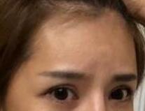 錫林郭勒去除抬頭紋2月真的優(yōu)惠嗎？