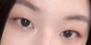 【分享我的双眼皮案例】摆脱肿眼泡，连同事都夸我变美了