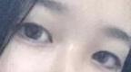 【闺蜜分享割双眼皮案例】万万没想到，睫毛还能达到上翘的效果