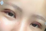 【全切双眼皮术后效果图】术后30天，眼睛变得实在是太美了！