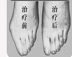 錫林郭勒寬腳變窄4月全新價格表上線了 3000-4000元/單側