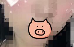 錫林郭勒自體脂肪墊下巴四月全新優惠上線了 8000-15000元/例 
