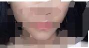 錫林郭勒自體脂肪除皺4月全新價(jià)格表很親民 6000-8000元/部位 