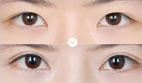 深圳丁峰医生割双眼皮技术怎么样？真实双眼皮案例见证实力