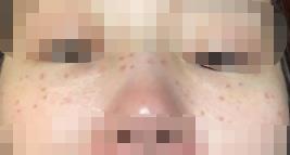 云南祛斑效果分享图 术后效果真不赖面部都变得光滑平整