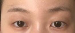 全切雙眼皮手術真人案例 術后三個月整個人的顏值提升了+效果圖
