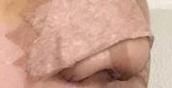 膨體隆鼻術后高清圖片：鼻子看上去很有立體感，顯得五官很精致